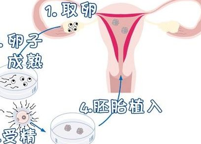 厦门174做试管婴儿手术的费用一共是多少？